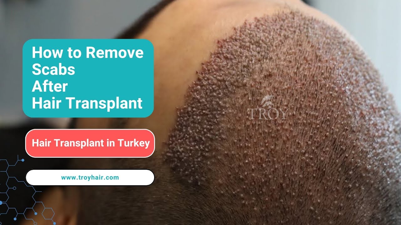Hair Transplant in Turkey | Removing Scabs After Hair Transplant | Troy Hair Transplant