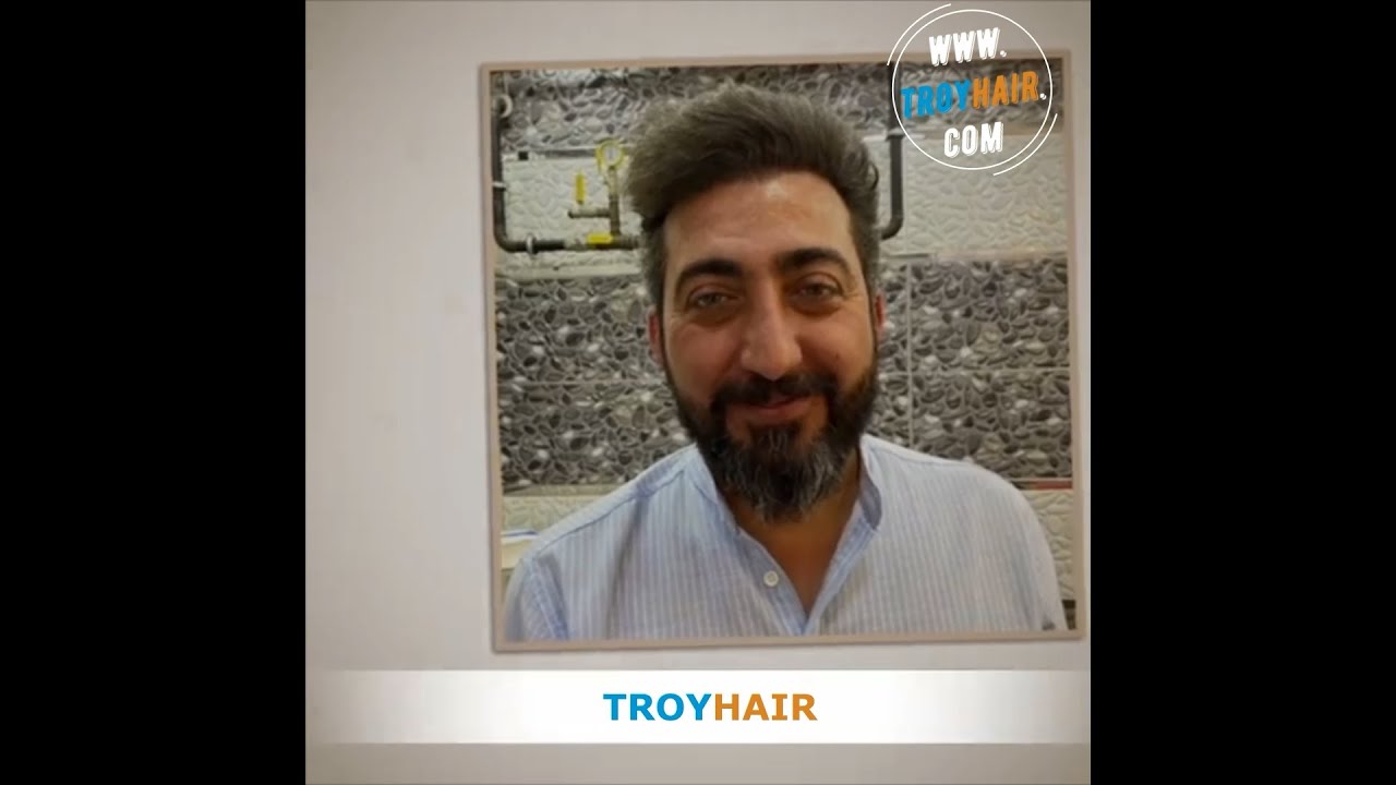 Result of 3000 Grafts Hair Transplant in Turkey Troy Hair / 터키 모발이식 3000모낭 결과 트로이헤어