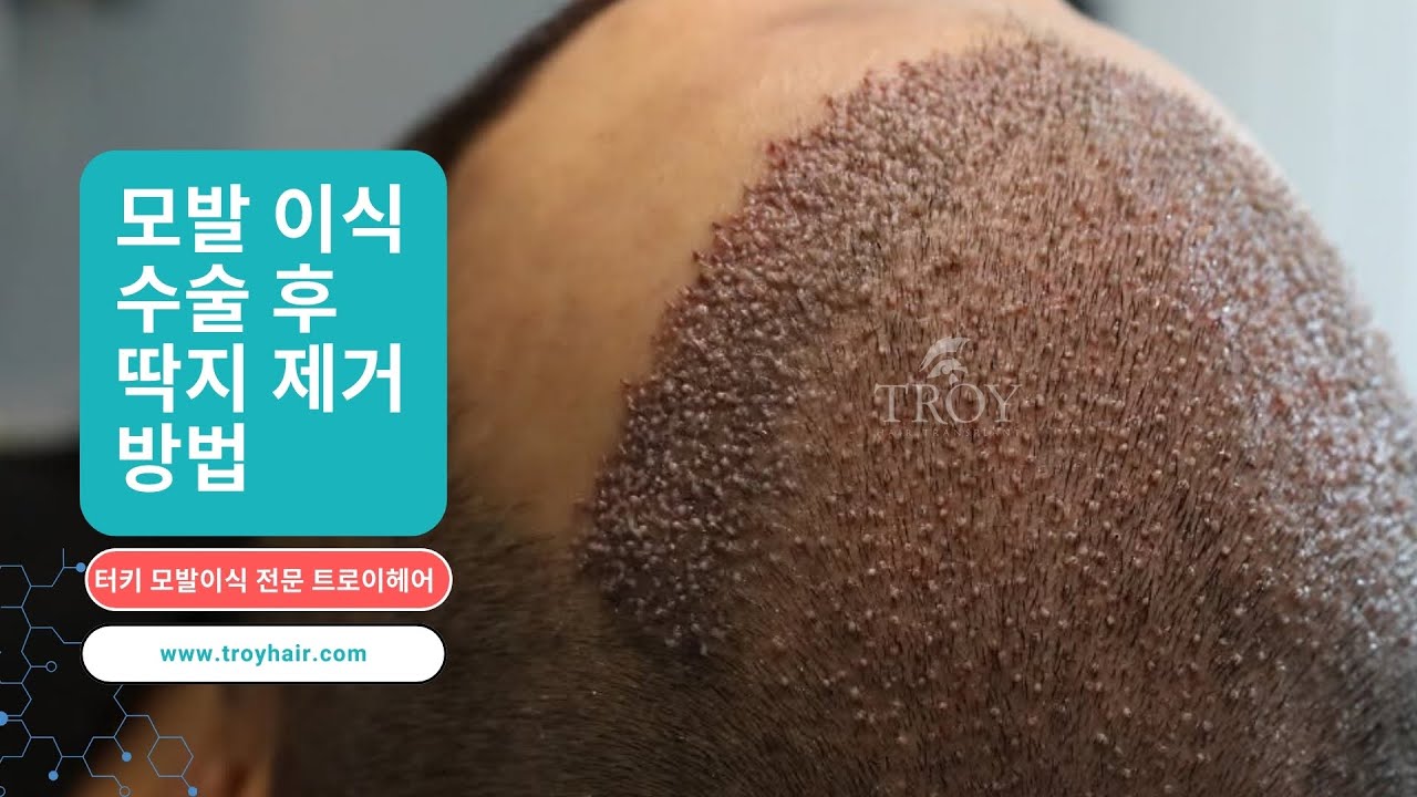 모발이식 수술 후 딱지 제거 | 터키 모발이식 전문 트로이헤어 | Troy Hair Transplant