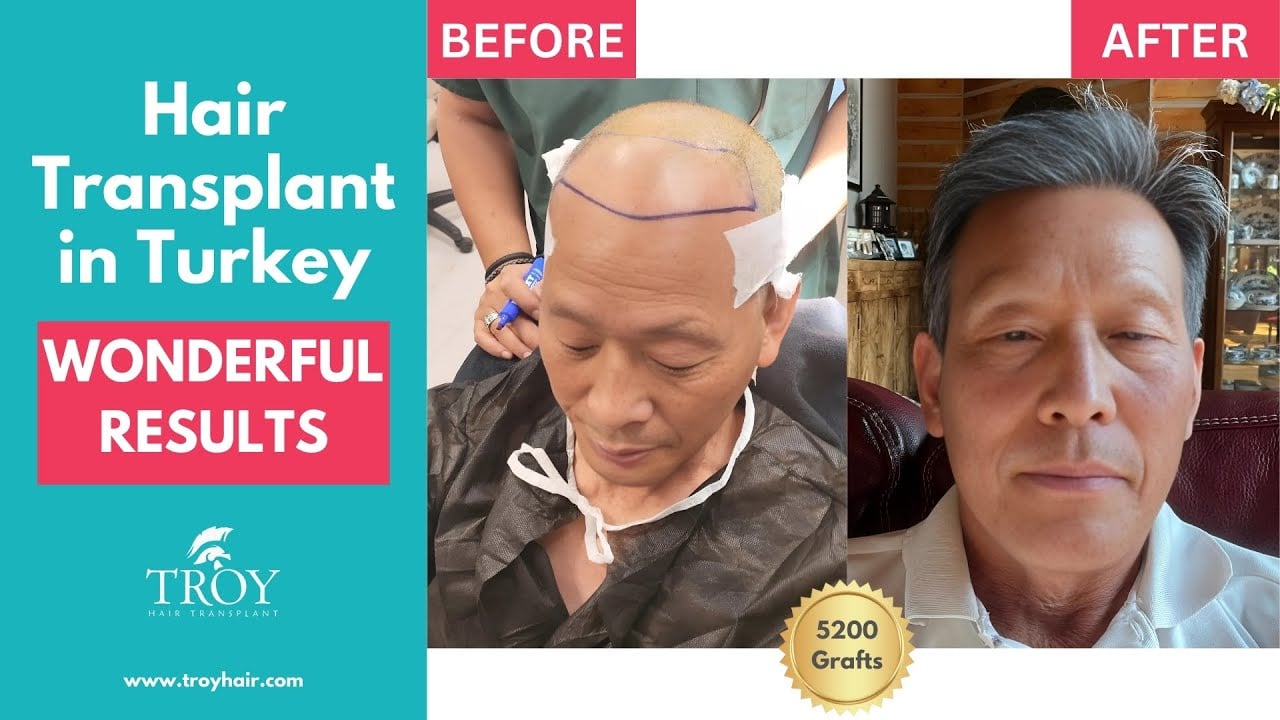 Hair Transplant in Turkey | Wonderful Results | Troy Hair Transplant