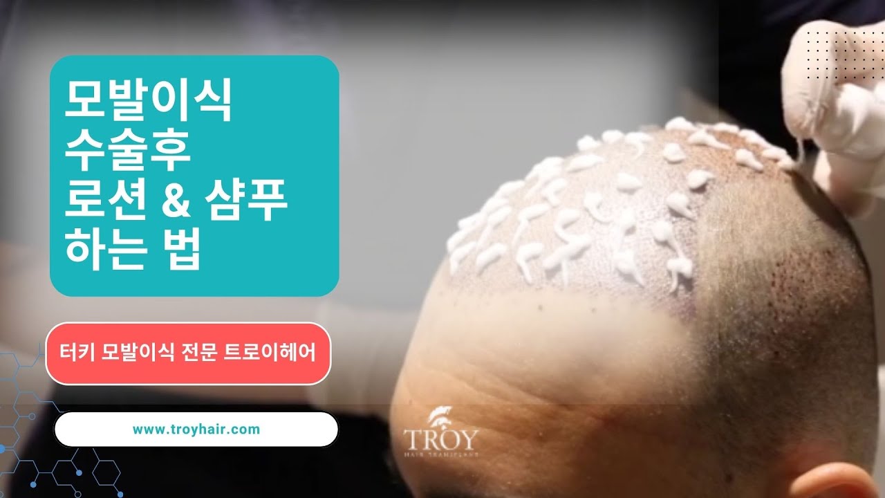 터키 모발이식 수술후 로션샴푸 하는 법 | 터키 모발이식 전문 트로이헤어 | Troy Hair Transplant