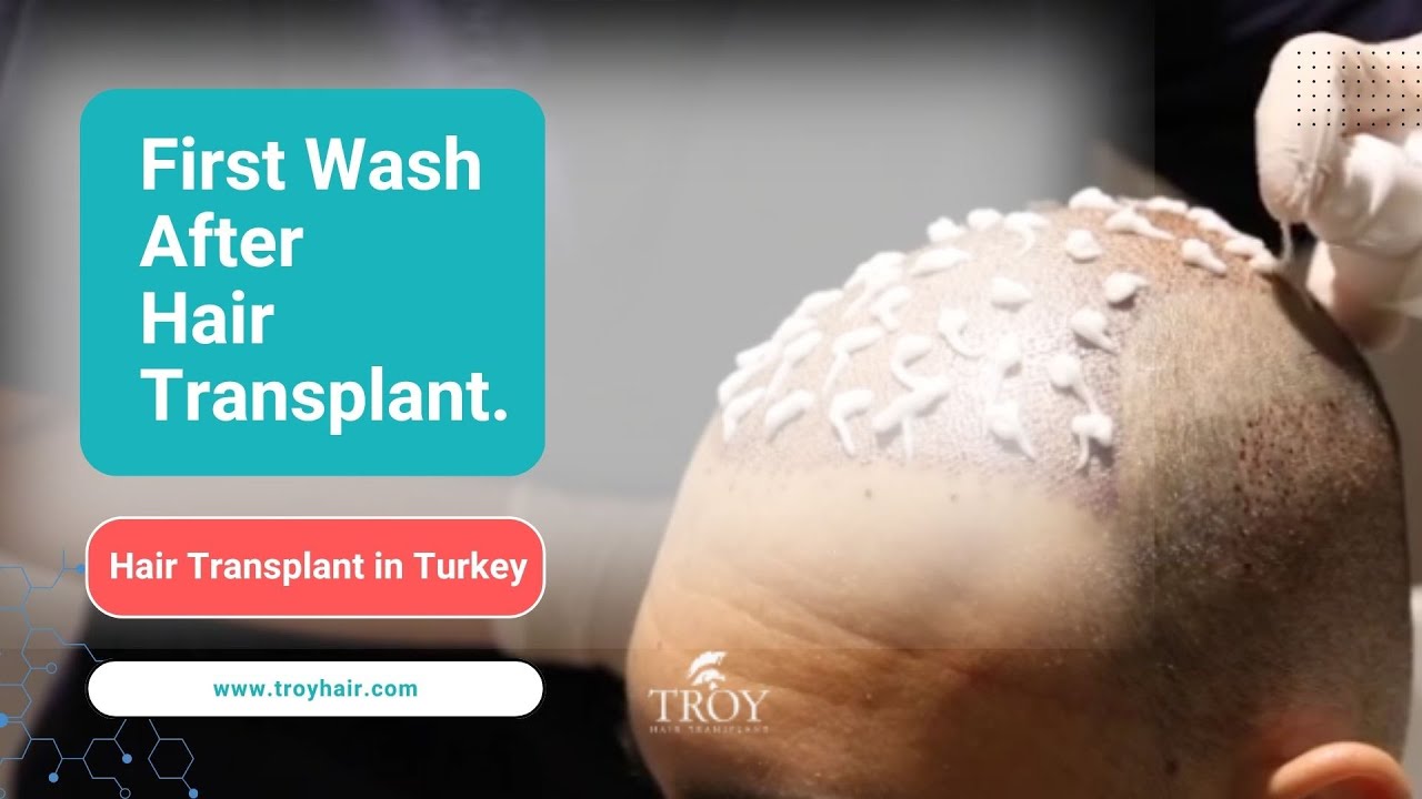 Hair Transplant in Turkey | First Wash After Hair Transplant | Troy Hair Transplant