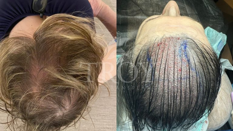 Female Hair Transplant