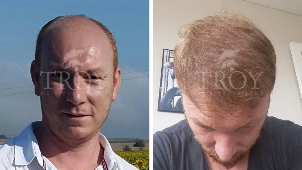 Fue Hair Transplant