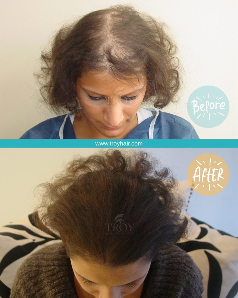 Hair Transplant For Women 1 Female Hair Transplant Before After