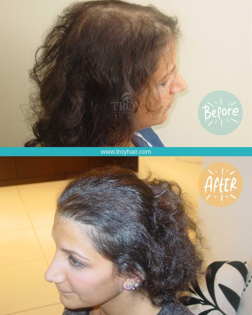 Hair Transplant For Women 2 Hair Transplant For Women Before After